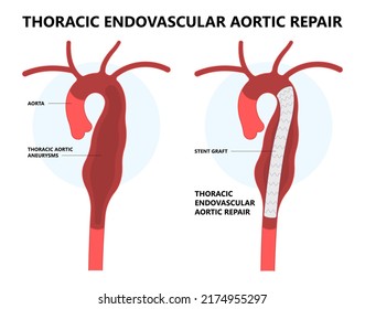 Heart Aorta Attack Aortic Arch Bulge Open Dilated Chest Renal Vein Clots Stent Stroke Marfan Root Left Graft Hernia Vessel Pain High Blood Kidney Damage Turner