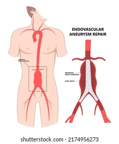 Heart Aorta Attack Aortic Arch Bulge Open Dilated Chest Renal Vein Clots Stent Stroke Marfan Root Left Graft Hernia Vessel Pain High Blood Kidney Damage Turner