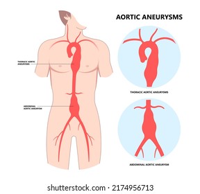 Heart Aorta Attack Aortic Arch Bulge Open Dilated Chest Renal Vein Clots Stent Stroke Marfan Root Left Graft Hernia Vessel Pain High Blood Kidney Damage Turner