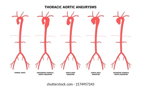 Heart Aorta Attack Aortic Arch Bulge Open Dilated Chest Renal Vein Clots Stent Stroke Marfan Root Left Graft Hernia Vessel Pain High Blood Kidney Damage Turner