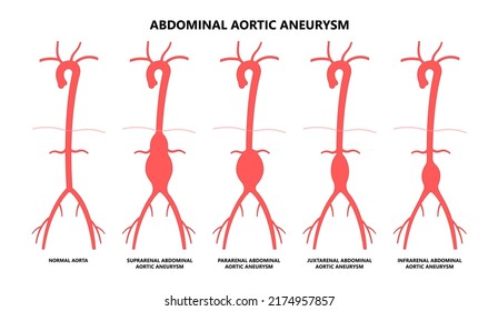 Heart Aorta Attack Aortic Arch Bulge Open Dilated Chest Renal Vein Clots Stent Stroke Marfan Root Left Graft Hernia Vessel Pain High Blood Kidney Damage Turner