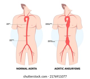 Heart Aorta Attack Aortic Arch Bulge Open Dilated Chest Renal Vein Clots Stent Stroke Marfan Root Left Graft Hernia Vessel Pain High Blood Kidney Damage Turner