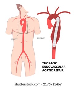 Heart Aorta Attack Aortic Arch Bulge Open Dilated Chest Renal Vein Clots Stent Stroke Marfan Root Left Graft Hernia Vessel Pain High Blood Kidney Damage Turner