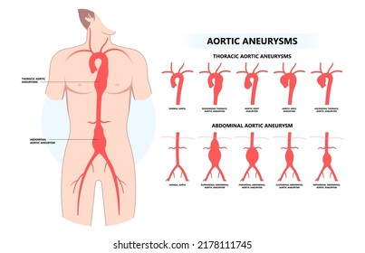 Heart Aorta Attack Aortic Arch Bulge Open Dilated Chest Renal Vein Clots Stent Stroke Marfan Root Left Graft Hernia Vessel Pain High Blood Kidney Damage Turner