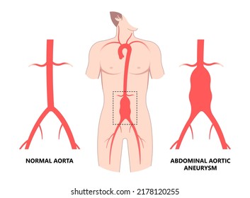 Heart Aorta Attack Aortic Arch Bulge Open Dilated Chest Renal Vein Clots Stent Stroke Marfan Root Left Graft Hernia Vessel Pain High Blood Kidney Damage Turner