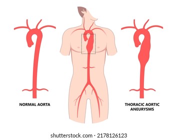 Heart Aorta Attack Aortic Arch Bulge Open Dilated Chest Renal Vein Clots Stent Stroke Marfan Root Left Graft Hernia Vessel Pain High Blood Kidney Damage Turner