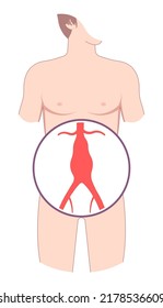 Heart Aorta Attack Aortic Arch Bulge Open Dilated Chest Renal Vein Clots Stent Stroke Marfan Root Left Graft Hernia Vessel Pain High Blood Kidney Damage Turner