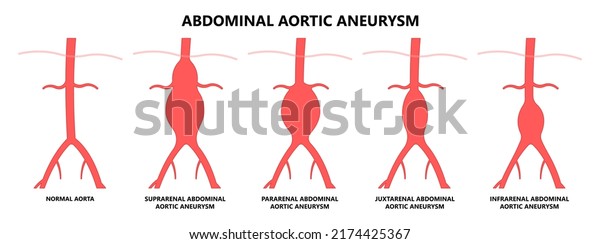 Aneurisma aórtico abdominal clasificación de la: vector de stock (libre ...