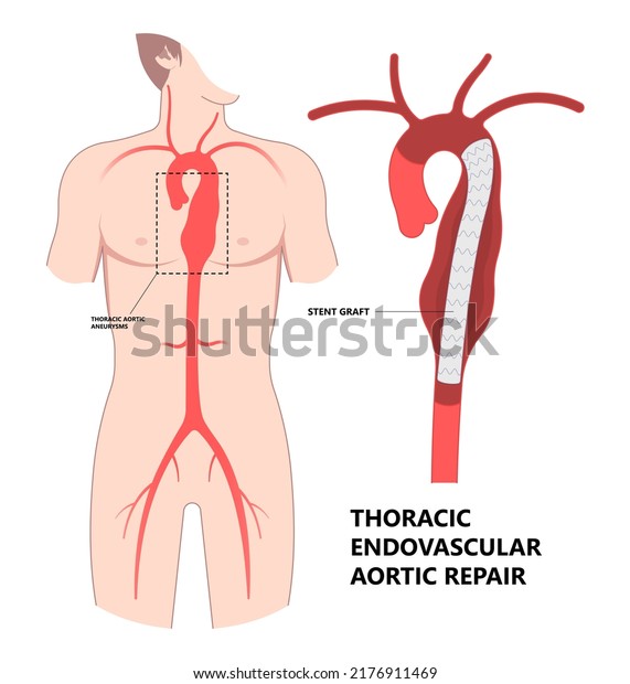 heart aorta attack aortic arch bulge\
open dilated chest renal vein clots stent stroke Marfan root left\
graft hernia vessel pain High blood kidney damage\
Turner