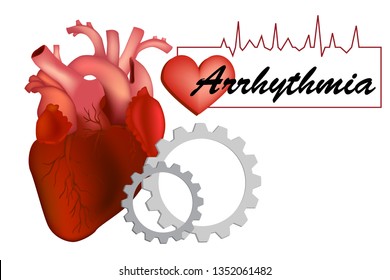 Heart arrhythmia (also known as arrhythmia, dysrhythmia, or irregular heartbeat).