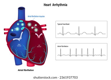 Vector de arritmia cardíaca. Arritmia cardíaca. Fibrilación auricular. Un latido irregular del corazón.