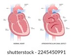 Heart and atrioventricular canal defect with septum Endocarditis Congestive Pulmonary hypertension