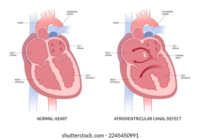 Die medizinische Anatomie vergleicht zwischen normalem Herzen und Vorhofferkrankung