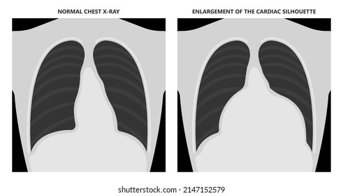 Heart attack acute chest pain injury difficulty breathing fat pads trauma fever shock viral bacterial fungal rate mRNA COVID-19 muscle dyspnea arrest unstable angina X-RAY diagnose Lupus virus cancer