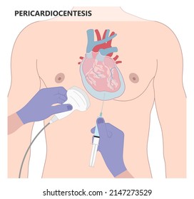 Heart attack acute chest pain injury difficulty breathing fat pads trauma fever shock viral bacterial fungal rate mRNA COVID-19 muscle dyspnea arrest unstable angina X-RAY diagnose Lupus virus cancer