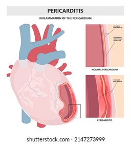 Heart attack acute chest pain injury difficulty breathing fat pads trauma fever shock viral bacterial fungal rate mRNA COVID-19 muscle dyspnea arrest unstable angina X-RAY diagnose Lupus virus cancer