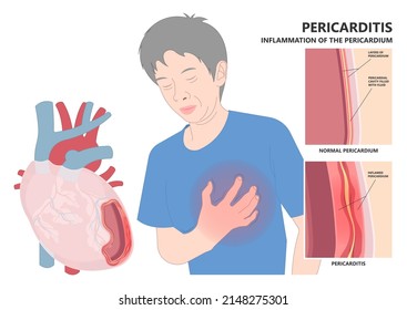 Síntoma del dolor torácico de la infección por derrame pericárdico que conduce al ataque cardíaco