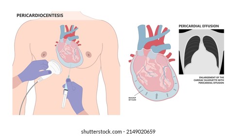 Heart attack acute chest pain injury difficulty breathing fat pads trauma fever shock viral bacterial fungal rate mRNA COVID-19 muscle dyspnea arrest unstable angina X-RAY diagnose Lupus virus cancer