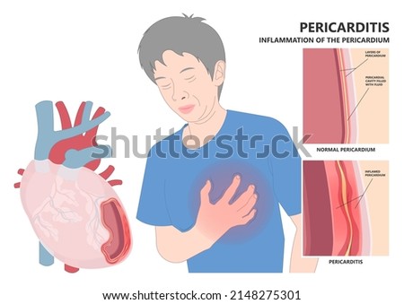 Heart attack acute chest pain injury difficulty breathing fat pads trauma fever shock viral bacterial fungal rate mRNA COVID-19 muscle dyspnea arrest unstable angina X-RAY diagnose Lupus virus cancer