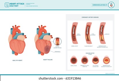 Heart attack and atherosclerosis medical illustration: healthy and damaged heart, blood vessel section with fatty deposit accumulation