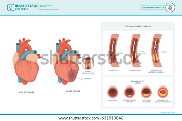 Heart attack and atherosclerosis medical\
illustration: healthy and damaged heart, blood vessel section with\
fatty deposit\
accumulation