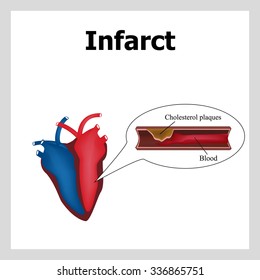 Heart attack. Atherosclerosis. Thrombus. Artery-clogging cholesterol. Cholesterol plaques. Infographics. Vector illustration.