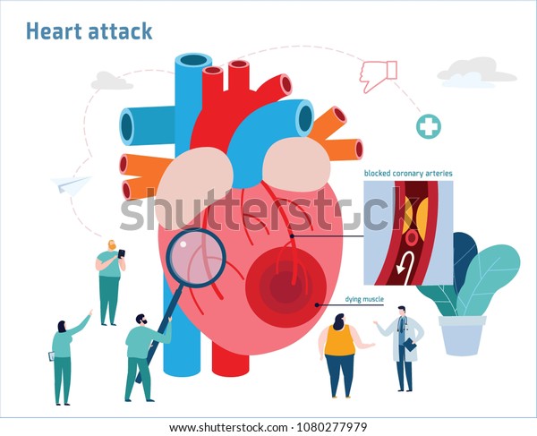 心臓発作のアテローム性動脈硬化症のベクターイラスト 医療のコンセプト ミニチュアの医師と看護師の専門家 の平らな漫画のアイコンデザイン ウェブバナーのモバイル背景 のベクター画像素材 ロイヤリティフリー