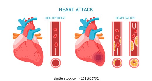 Heart Attack And Cardiovascular Diseases Infographic. Healhty And Failure Hearts, Atherosclerosis Symptoms And Diagnosis. Flat Vector Illustration. Design For Medicine, Treatment, Health Care Concept