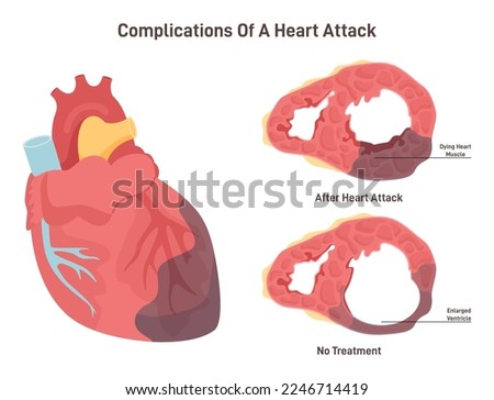 Heart attack complications. Heart wall thinning and ventricle enlargement. Dying myocardium muscle cells. Flat vector illustration