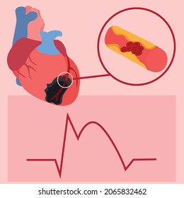 Ilustración de ataque cardíaco. La ilustración muestra ECG para infarto de miocardio, trombosis de arteria coronaria y necrosis miocárdica.