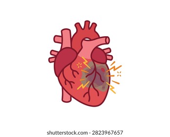 Heart Attack Illustration Representing Myocardial Infarction and Cardiac Pain