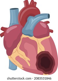 ilustración de ataque cardíaco que muestra la infarción del lado anterior del corazón