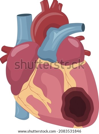 heart attack illustration showing infarction of anterior side of heart
