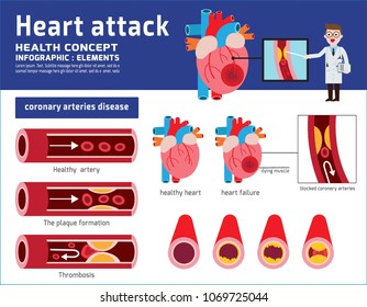 Heart attack infographic.Atherosclerosis medical illustration. Healthcare concept.healthy and damaged heart.blood vessel section with fatty deposit accumulation.Vector icon flat cartoon design