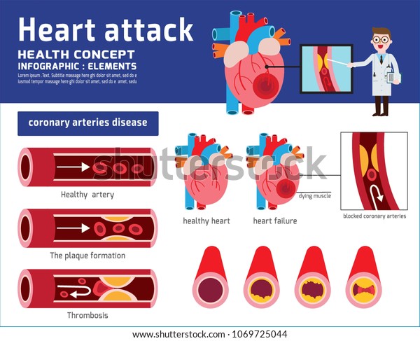 心臓発作のインフォグラフィック アテローム性動脈硬化症の医療イラスト 医療のコンセプト 健康で傷ついた心臓 脂肪沈着を伴う血管部 ベクター画像アイコンフラットカートーンデザイン のベクター画像素材 ロイヤリティフリー