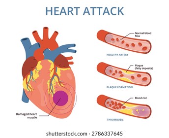 Heart attack. Medical educational poster, anatomy of human organ, blood flow in aorta, arterial thrombosis, muscle and artery cross sections, cardiovascular circulation nowaday vector infographics