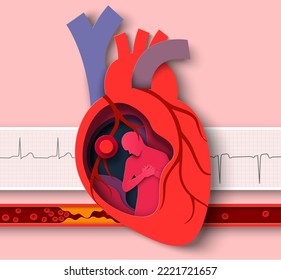 Heart Attack Paper Cut Vector. Cardiology Disease Medical Poster. Anatomy Of Human Cardiovascular Organ Abstract Design And Cardiogram, Atherosclerotic Vessel Illustration