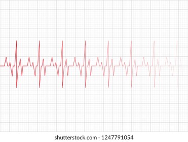 Electrocardiogram Show Premature Ventricular Contraction Pvc Stock ...