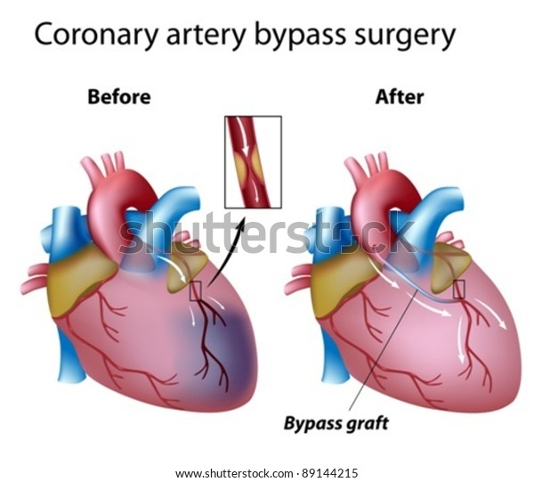 Heart bypass\
surgery
