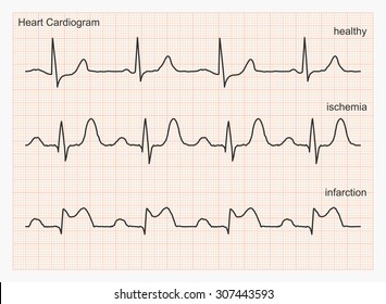 Heart cardiogram waves. Three types of cardiograms: healthy heart rhythm, ischemia, infarction. Graph paper with ECG graphic line. Vector illustration.