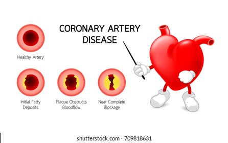 Coronary artery atherosclerosis