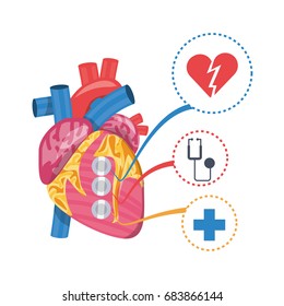 heart condition to infarction prevention