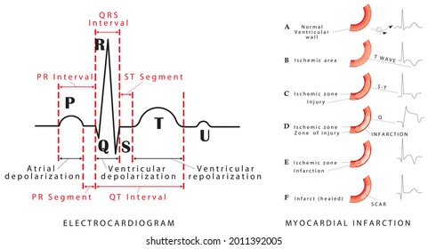 The heart cycle. Normal ECG. Myocardial infarction - ECG. Wave changes during evolution of myocardial damage. Myocardial infarction in the posterior wall and an occlusion of the circumflex artery.