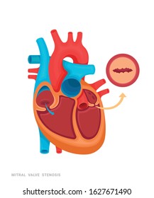 Heart defect. Mitral velve stenosis. Illustration for medicine books, websites, apps. Heart disease with name.