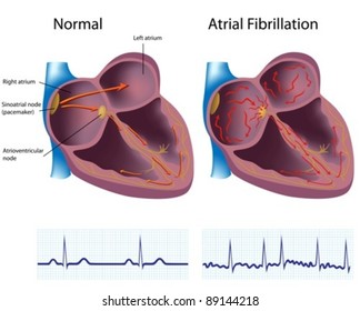 Heart Disease - Atrial Fibrillation