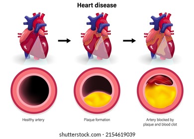 Heart Disease. Coronary Artery Syndrome. Causes Of Myocardial Ischemia. Atherosclerosis Vector.