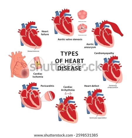 Heart disease types. Medical vector illustration of aortic valve stenosis, aortic aneurysm, cardiomyopathy, thickening of myocardium, heart defect, arrhythmia and ischemia, pericarditis, heart failure