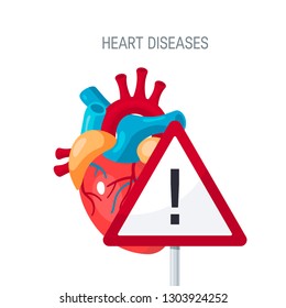 Heart diseases concept. Vector illustration for articles, educational textbooks, web banners etc. in flat style