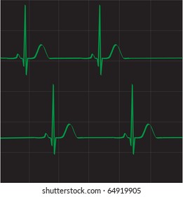Heart electrocardiogram. Heart beat rate. Heart beats vector.