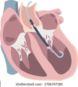 Heart Failure With Impella Support Of Left Ventricle